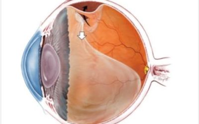 Do you have a vitreous detachment?